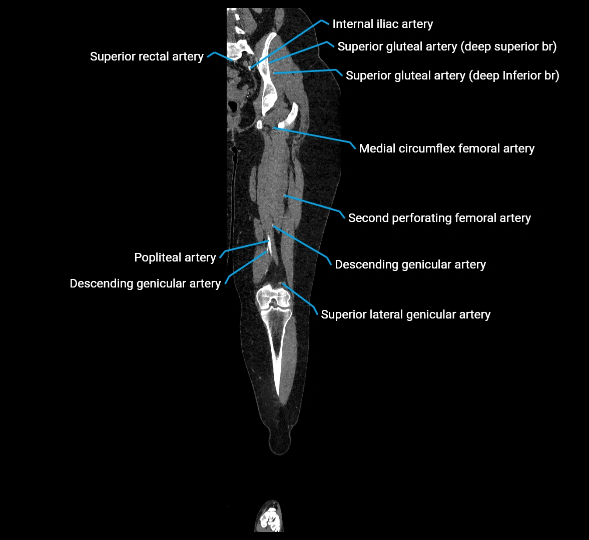 CTA lower limb coronal cross sectional anatomy labelled image _48 (2).webp